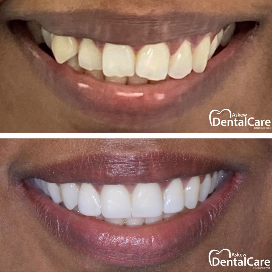 askew dental after before