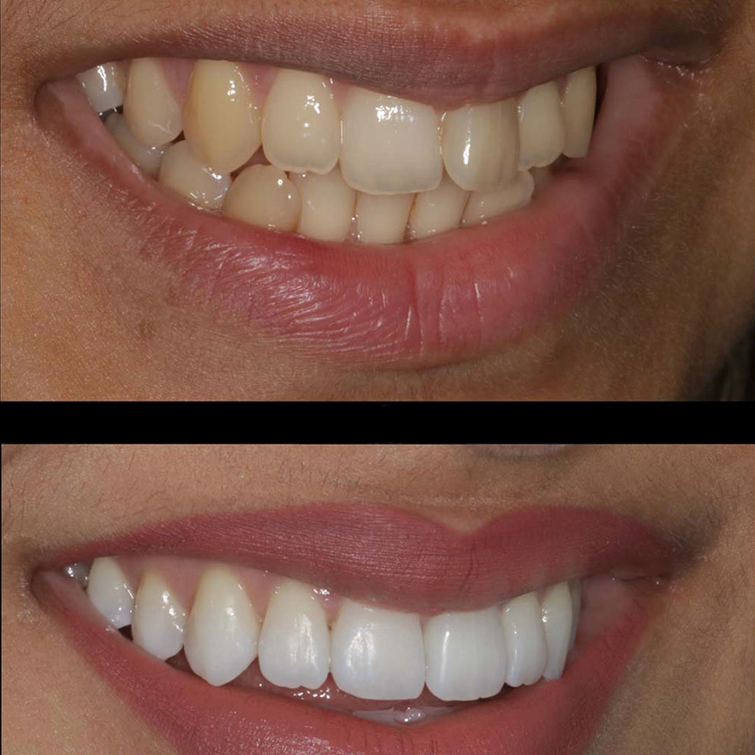 after-before-teeth-whitening