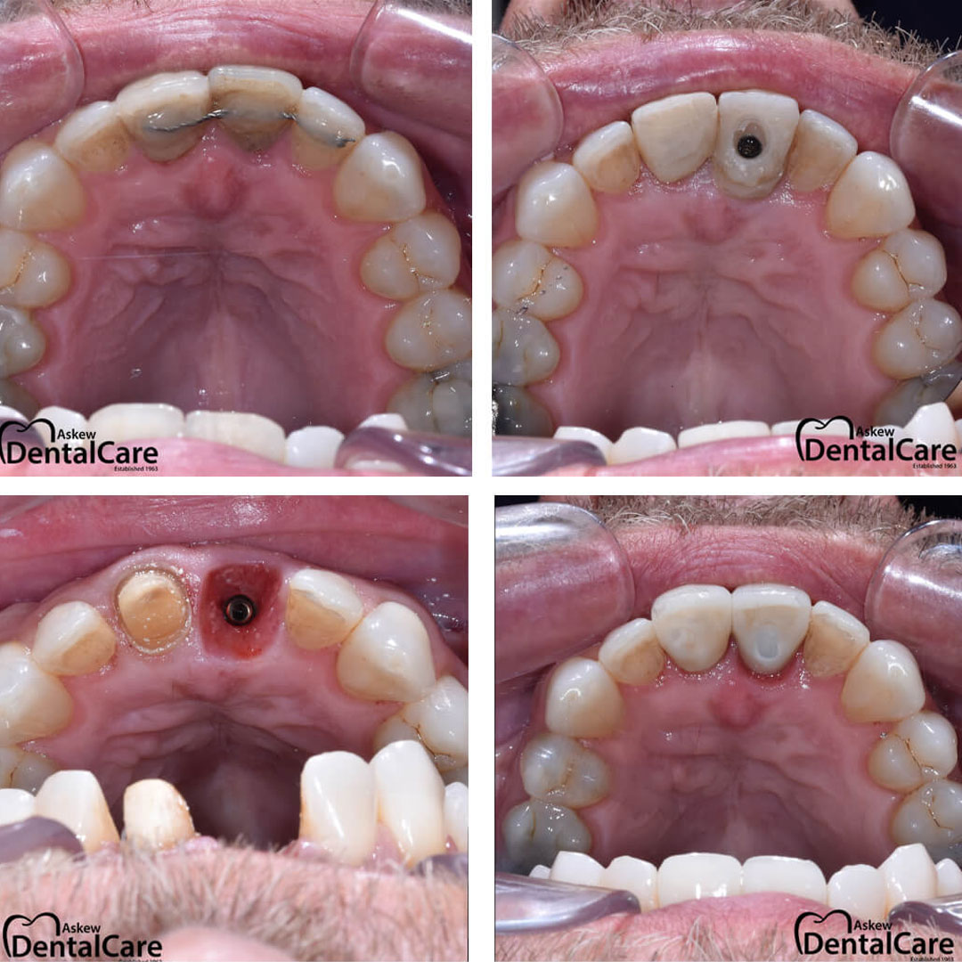 before-after-dental-implant