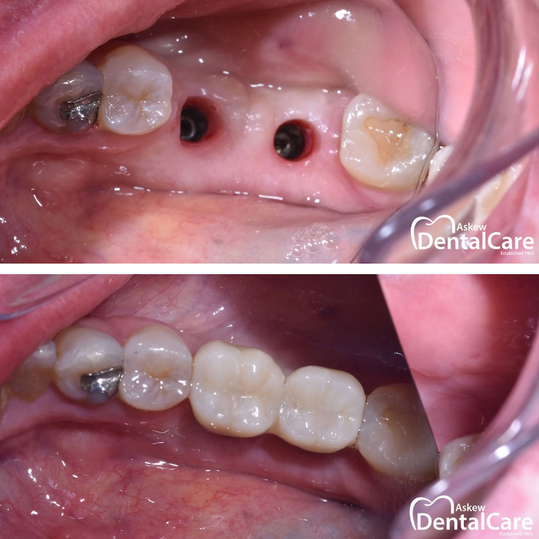 dental-implants